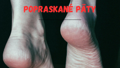 Praskliny na patách: Co za nimi stojí a jak se jich zbavit? | ARNO.cz - obuv s tradicí